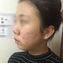 제산한의원 | 여드름 한의원 실비 여부&amp;다녔던 이유 정리해용