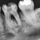 오케이치과의원 | [의왕치과/오케이치과]잇몸뼈가 다 녹았는데 안 뽑는다고요? 정확한 원인을 찾으면 기적처럼 뼈가...