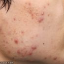 한스클리닉의원 | 응암역피부과 겨울방학 여드름관리 신중해야되는 까닭? (실비 화장품)