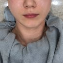 노원사우나 | 노원 피부과 온다리프팅 6만줄, 이중턱 브이올렛 후기|전문의 상담, 비대칭 교정 리뷰