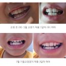 쭈노 | 반대교합 프리올소ㆍ가철형 교정장치 [어린이 예방교정치료] 11개월 차 진료 후기