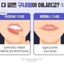 잇몸 혀 구내염 증상과 원인 전염이 될까? 빨리 낫는 법 이미지