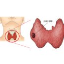 갑상선 결절 (Thyroid Nodule) 이미지