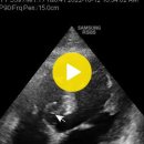 aneurysmal change perimembraneous ventricular septum(심근 중격 동맥류) 이미지