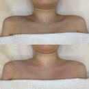 꼬미에스테틱 하남미사점 | 하남미사 웨딩관리 꼬미에스테틱 하남미사점 직각어깨 효과(전,후 사진O)