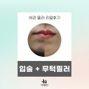 압구정 입술필러 &amp; 무턱, 마리오네트 필러 리얼후기_이유클리닉