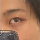 (주) 한밭메디칼 | [LA] 다섯째달 후기 / 다래끼