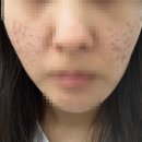 가산한의원 | [가산 한의원] 여드름패인흉터 제거 - 새살침 후기