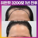 [20대 여자 매우 깊은 M자 헤어라인 머리심기] 비절개 히든컷 모발이식 3200모 1년 후기 (모엠의원/헤어라인/전지훈원장) 이미지