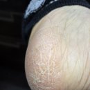 우아해 | 인천 패디플래닝 추천 | 발 뒷꿈치 갈라짐 각질제거 • 찐솔직후기 I ‘우아해 뷰티’