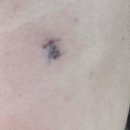 비엘클리성형외과의원 | 부평 볼 피지낭종 수술+콘투락투벡스 겔 내돈내산 후기