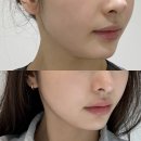 강남역리프팅맛집 볼뉴머600샷 내돈내산 일주일 후기 김나영리프팅효과