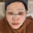 타이탄 짐 | 잠실새내역 피부과 이브타이탄 시술후기 중안부 리프팅 효과