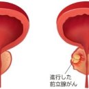 전립선암이 발견돼도, 치료하지 않고 경과를 관찰하는 것은 어떤 경우？ 이미지