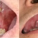혹시 이게 구강암?… ‘2주 이상 구내염+혀 반점’ 확인! 이미지
