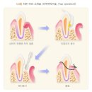 특정 치주질환(잇몸질환) 치료비 특별약관[무배당 삼성화재 다이렉트 치아보험 자동갱신형 2304.8] 이미지