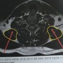 견갑거근 이미지