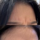 유앤피부과의원 | 분당 유앤아피부과 내돈내산 미간보톡스 1회차후기