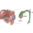 담낭 용종 (GB Polyp) 이미지