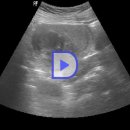 Submucosal uterine myoma 이미지