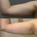 바비필라테스 | 팔뚝살빼기, 셀룰라이트 제거와 피부탄력까지 바비튠 100% 리얼 후기