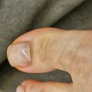 네일홀릭(NAIL HOLIC) | [주안 짱구 네일 ] 내성 발톱 교정 + 여름 패디 큐어 디자인 추천!! *내돈내산 후기*