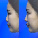 바른미이비인후과의원 | 맞춤형 코성형의 혁명, 핏미코 성형외과 방문 상담 후기