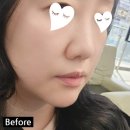 엘스약국 | [4월 일상] 엘스코 코실리프팅 후기(통증,붓기,멍) 수원인계동피부과