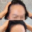 압구정 SMP 두피문신 70대 여성 헤어라인·정수리 전체 작업 후기