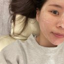 피코네일 - 서구 월평동로26번길 37 | 상왕십리 에스테틱에서 하이푸, 물방울 리프팅, 피코토닝 관리받은 후기 :: 리디아뷰티 왕십리센트라스점