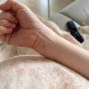 베스티안병원 | 세종 임산부 화상은 화상전문병원으로 가세요! 오송 베스티안 병원 손목 화상 치료 후기