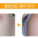 안성열성형외과피부과의원 | 켈로이드, 효과적인 치료 방법은? 강남 켈로이드 제거 잘하는곳 신사 안성열성형외과피부과