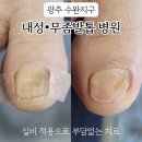 파리바게뜨이충2지구점 | 광주 내성 무좀발톱 병원 수완지구 부담 없이 치료받은 후기