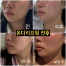 돋보기피부과의원 | 서면 피부과 온다리프팅 , 팻프리 주사 당일부터 2주 후기