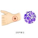 화농성 질환(창양)