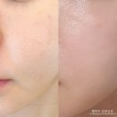 란 스킨 | 고주파시술 모공레이저 더블타이트 + 쥬베룩 스킨부스터 내돈내산 후기! (신사역피부과)