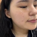 구로피부관리 [콜라스터 넥소좀] 네번째 후기