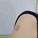 예진유치원 | 중구보건소 B형간염 예방접종 1~3차 후기 (비용, 주기, 주의사항)