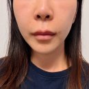 울쎄라프라임 300샷 붓기 팔자주름 심부볼 울쎄라 효과 일주일 차 후기