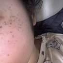 주근깨 레이저 내돈내산!!(루비레이저 후기)