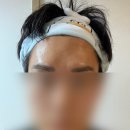 블리비의원 | 평택 보톡스 후기 (블리비의원 평택점)