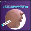 플로라성형외과의원 | 플로라성형외과의 빠르고 간편한 돌출입수술후기 리얼스토리