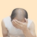 서면정수리탈모 있는데 상투를 틀어야 한다면