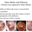 소리귀보청기 이미지