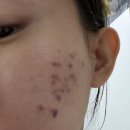 시전 | 무친 파인 여드름흉터(롤링형) 치료일기: 서브시전+쥬베룩 1회차 | 내돈내산, 전후사진, 솔직후기