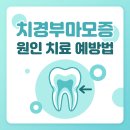 통증 예방 치료 기체조 | 치경부마모증 원인 치료 예방법과 레진 가격 비용 총정리