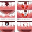 잇몸 부었을때 잇몸 내려앉음 잇몸 염증 잇몸 고름주머니 이미지