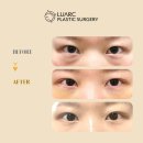 루아크성형외과의원 | 강남눈밑지수술 어디서 해야할지 고민인 분들이라면 -루아크성형외과