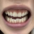 치아친구치과기공소 | 인천 계양구치과 추천! 전문가 치아미백 후기