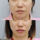 얼굴실리프팅, 하안면 처짐 고민 먼저 읽어보세요 | 실리프팅 후기 사진 | 바이미성형외과